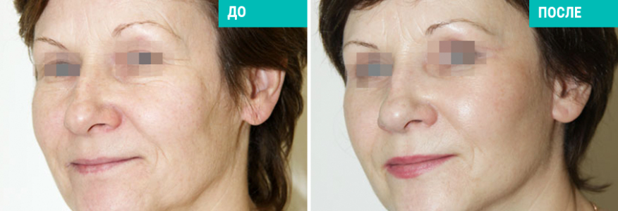 Одномоментная подтяжка лица и шеи и круговая блефаропластика 