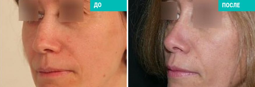 Ринопластика