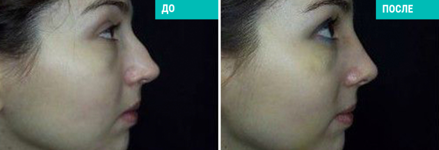 Ринопластика