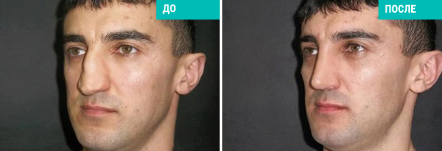 Ринопластика