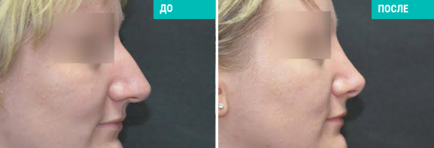 Ринопластика