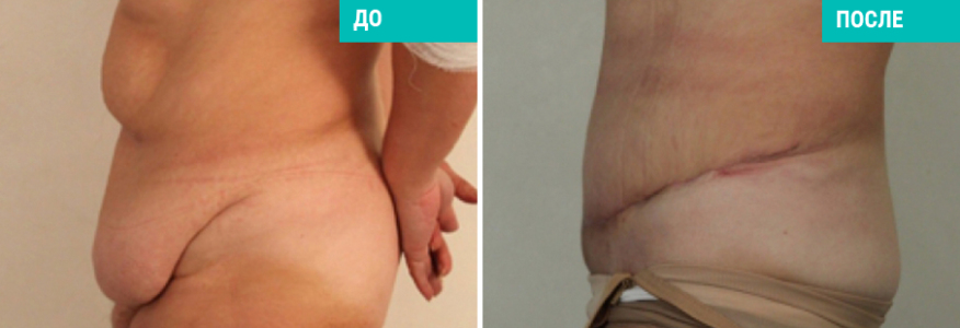 Абдоминопластика