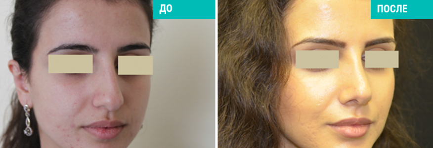 Ринопластика