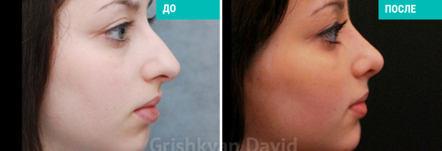 Ринопластика