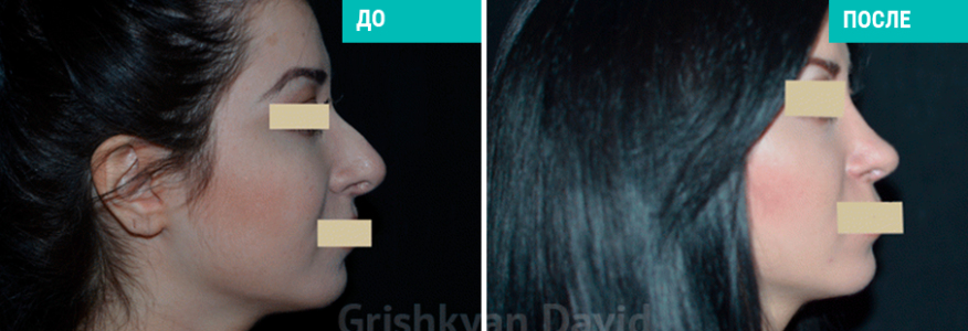 Ринопластика