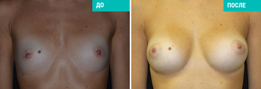 Увеличение груди