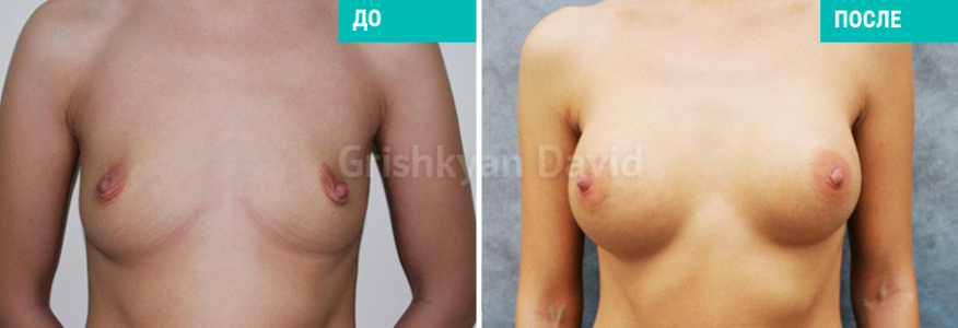 Увеличение груди