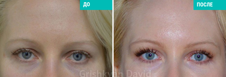 Блефаропластика 