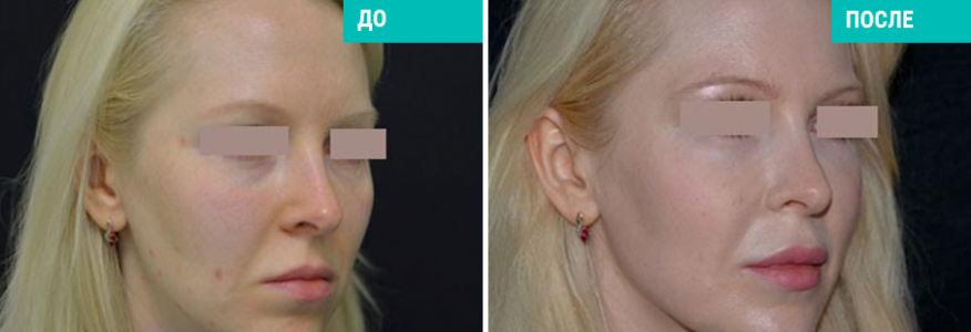 Липофилинг лица