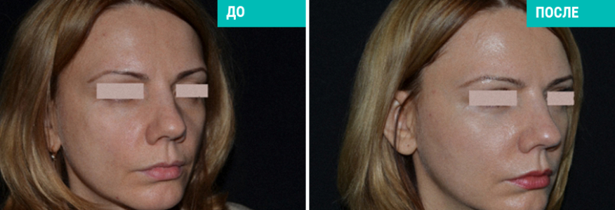 Липофилинг лица