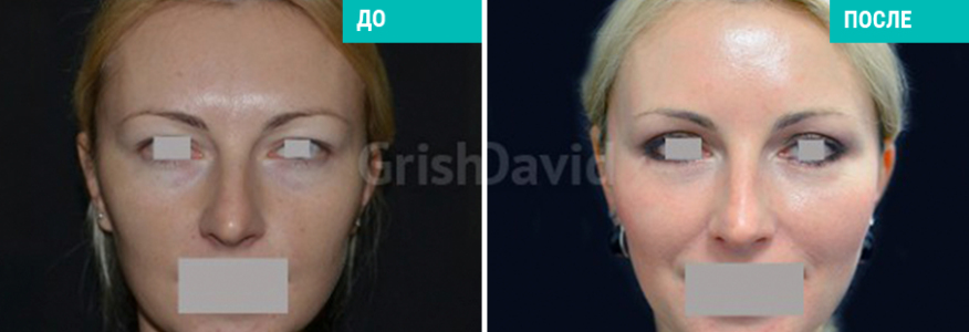 Липофилинг лица