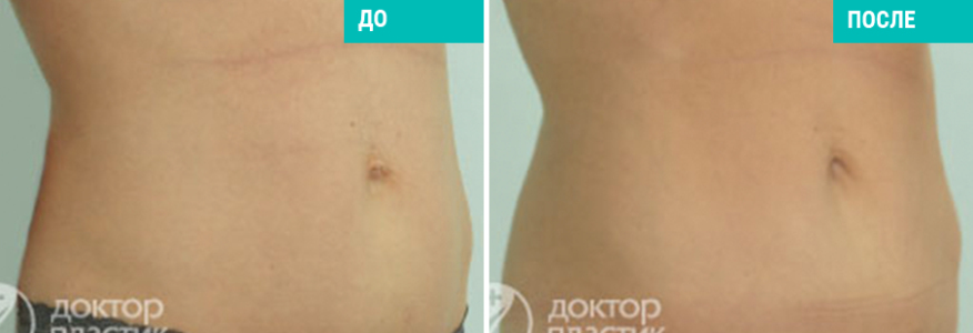 Подтяжка живота