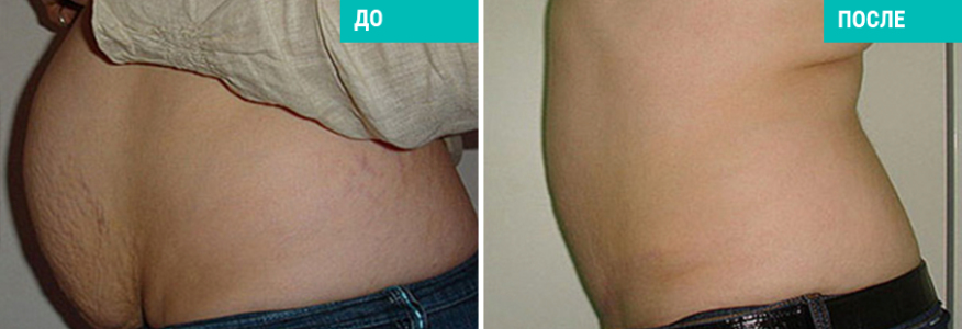 Подтяжка живота