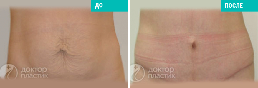 Подтяжка живота