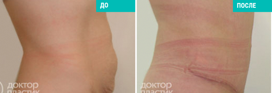 Подтяжка живота