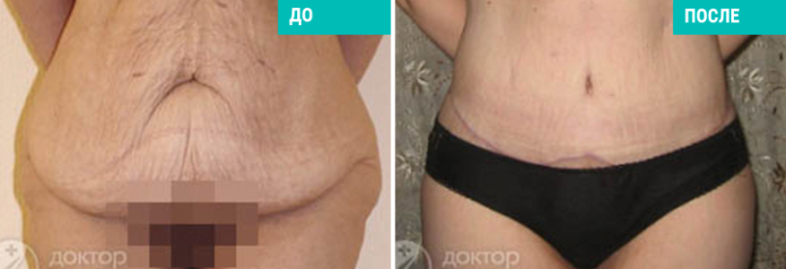 Подтяжка живота