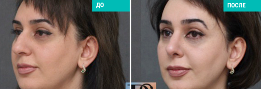 Ринопластика