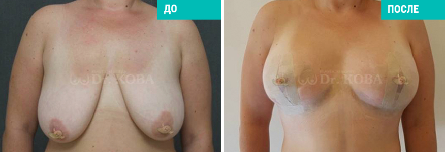 Маммопластика