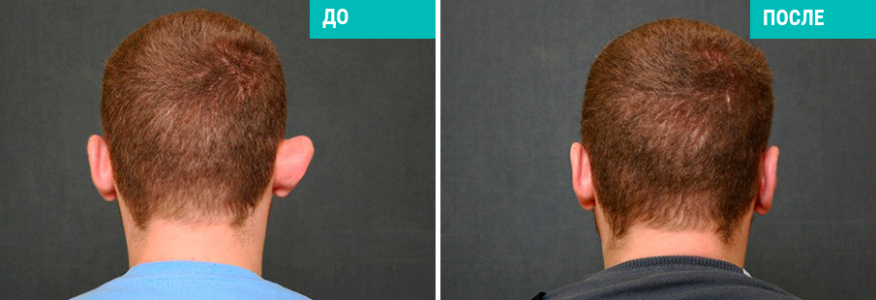 Отопластика