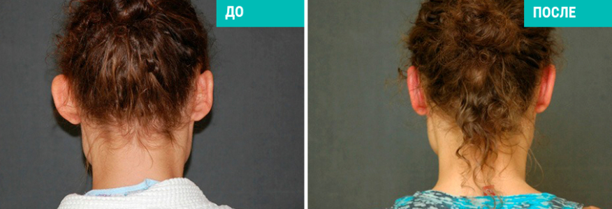 Отопластика