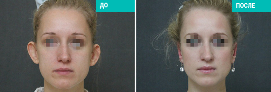 Отопластика