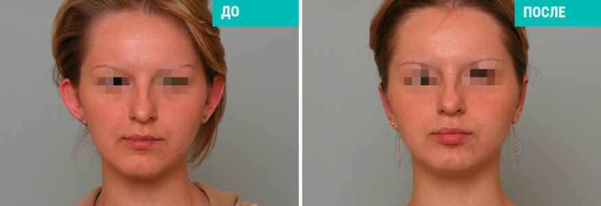 Отопластика