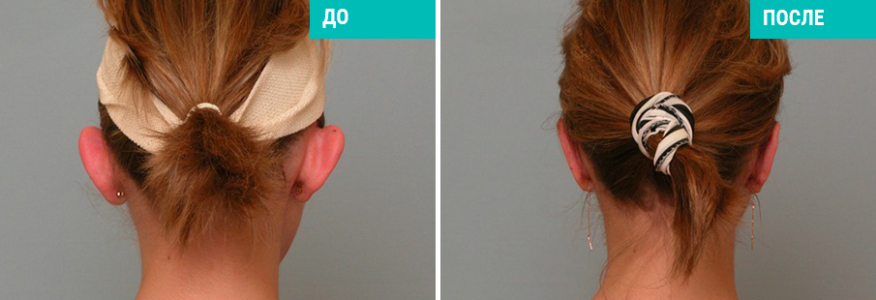 Отопластика