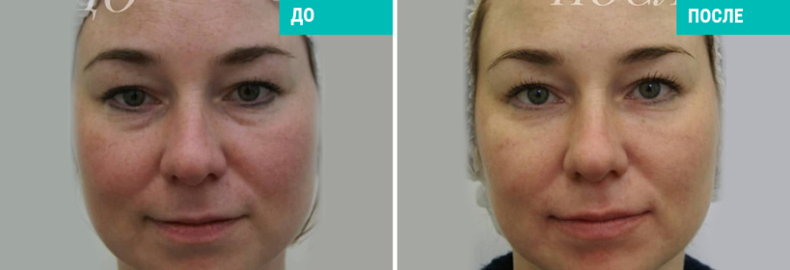 Контурная пластика филлером