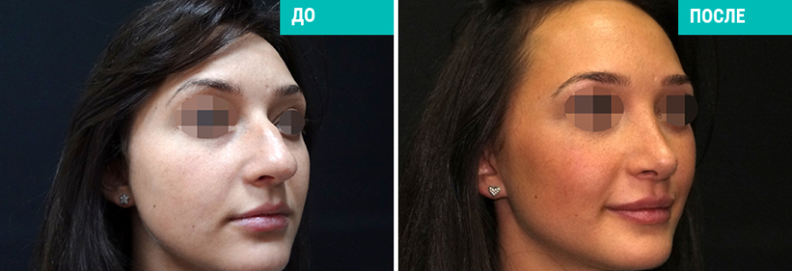 Ринопластика