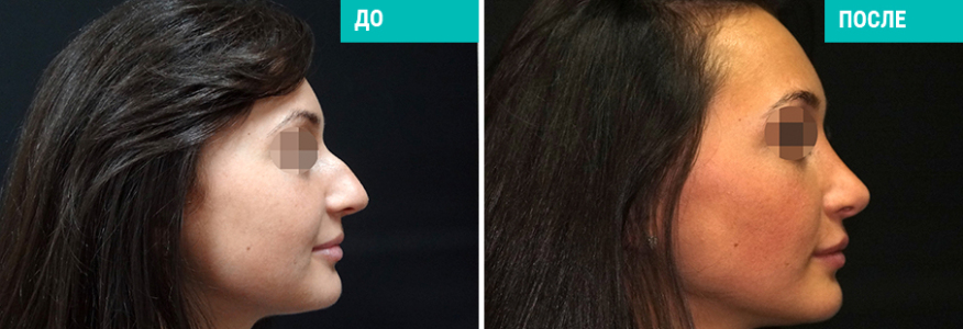 Ринопластика