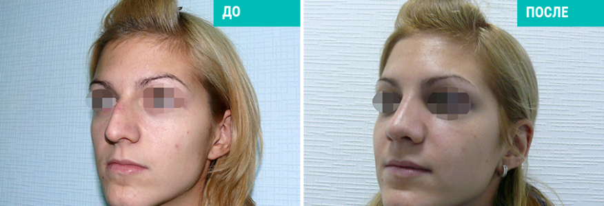 Ринопластика