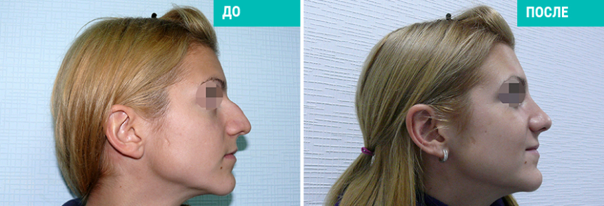 Ринопластика