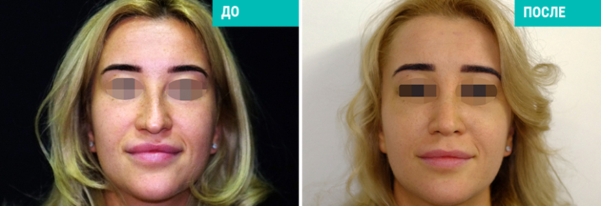 Ринопластика