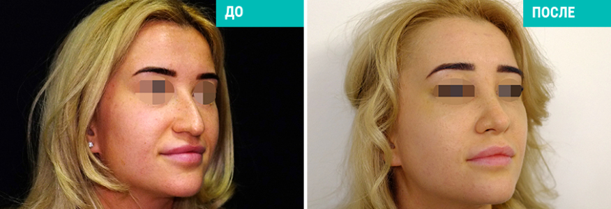 Ринопластика