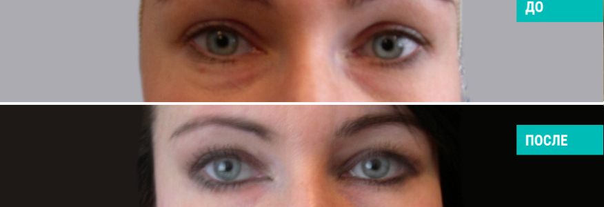 Блефаропластика