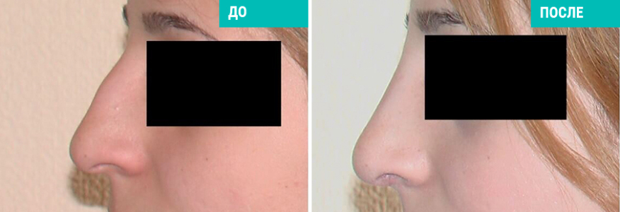 Ринопластика