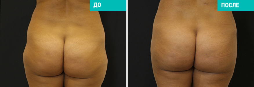 Липосакция