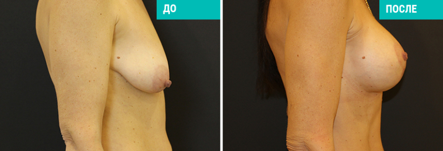 Подтяжка груди