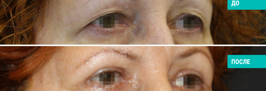 Блефаропластика