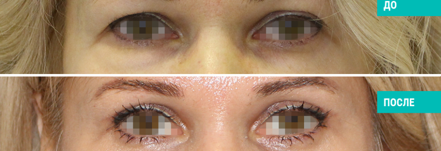 Блефаропластика