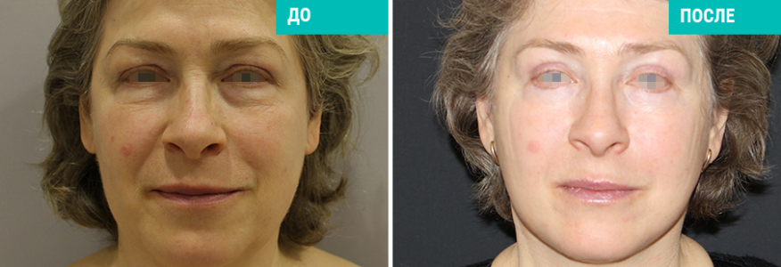 Пластика лица