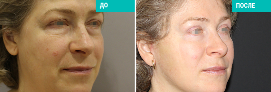 Пластика лица