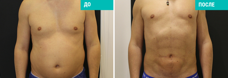 Vaser-липосакция