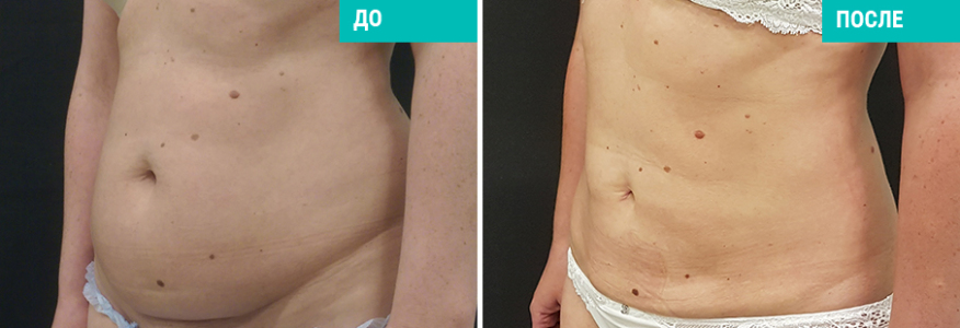 Vaser-липосакция