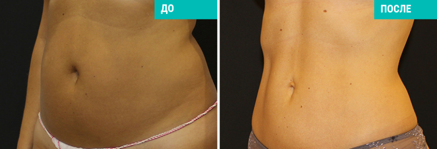 Vaser-липосакция