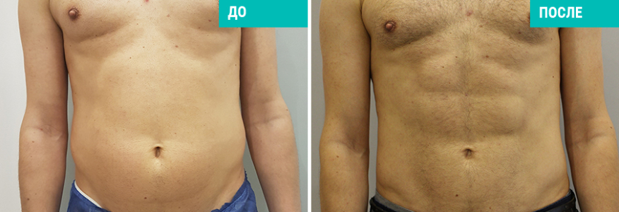 Vaser-липосакция