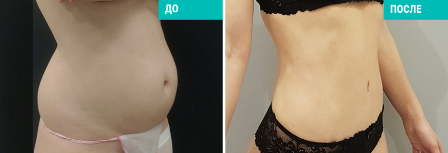 Абдоминопластика