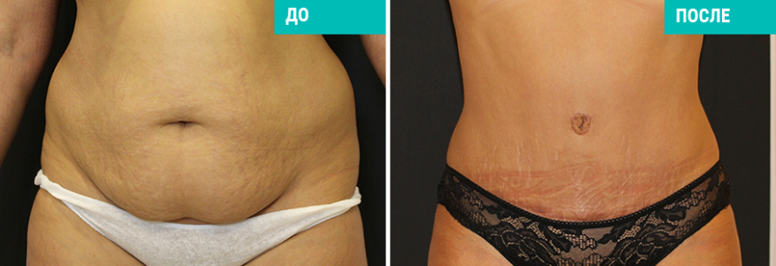 Абдоминопластика