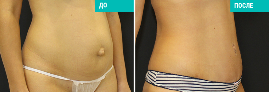 Абдоминопластика