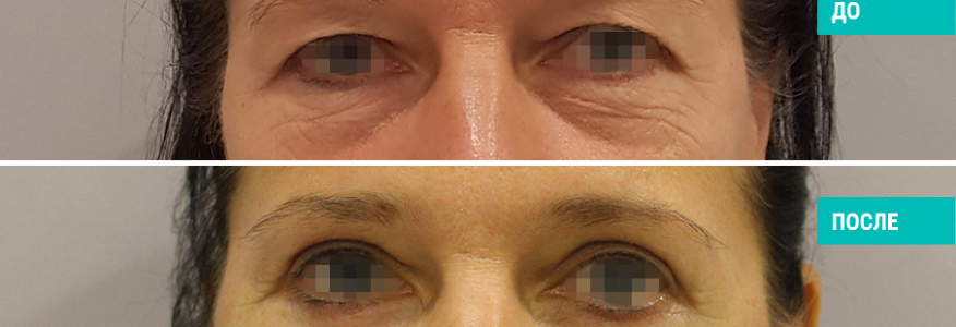 Блефаропластика